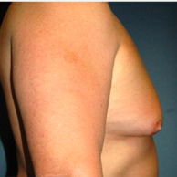 50 year old man treated with Male Breast Reduction before 3720893