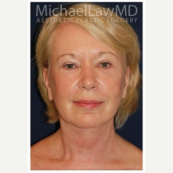 55-64 year old woman treated with SMAS Facelift after 1549135