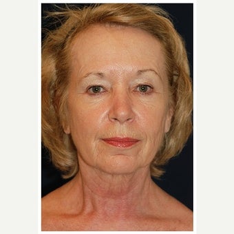 55-64 year old woman treated with SMAS Facelift before 1549135