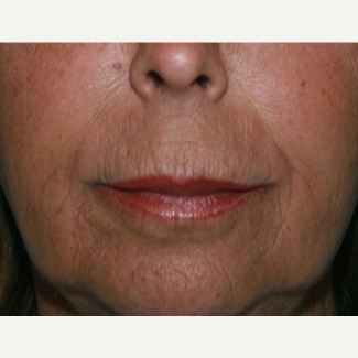 55-64 year old woman treated with Restylane Silk after 3345045