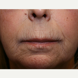 55-64 year old woman treated with Restylane Silk before 3345045