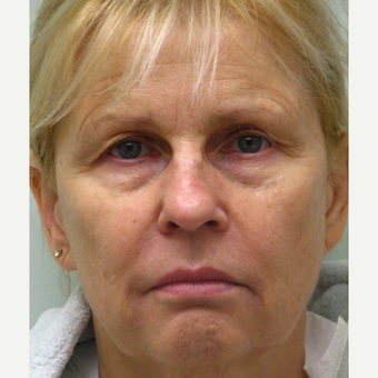 55-64 year old woman treated with Liquid Facelift and Lip Augmentation before 3243172