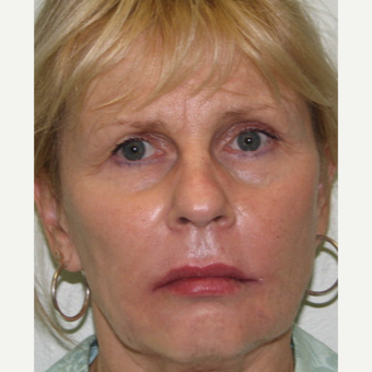 55-64 year old woman treated with Liquid Facelift and Lip Augmentation after 3243172