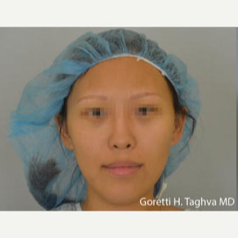 18-24 year old woman treated with Fat Transfer before 3578483