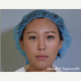 18-24 year old woman treated with Fat Transfer after 3578483