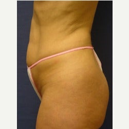 45-54 year old woman treated with Mini Tummy Tuck before 2066866