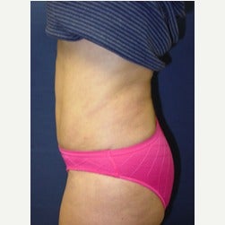 45-54 year old woman treated with Mini Tummy Tuck after 2066866