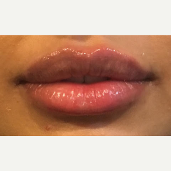 35-44 year old woman treated with Lip Augmentation after 3738104