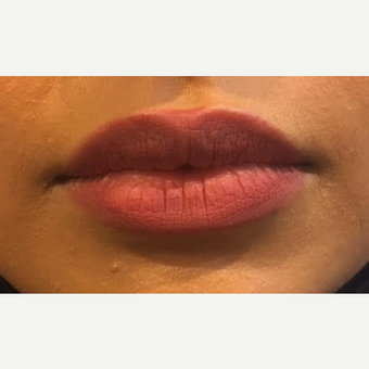 35-44 year old woman treated with Lip Augmentation before 3738104