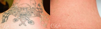 tattoo removal before 1090083