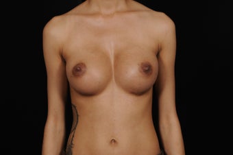 Breast Augmentation for Slender Body Type after 1364862