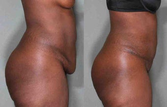44 Year Old Female Treated for Unwanted Belly Fat before 1046564