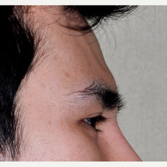 25-34 year old man treated with Forehead and Brow Augmentation before 2452917