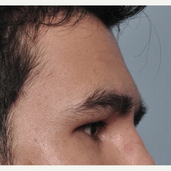 25-34 year old man treated with Forehead and Brow Augmentation after 2452917