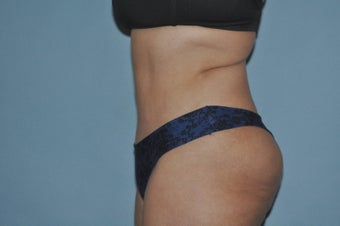 45-54 year old woman treated with Drainless Tummy Tuck 1672440