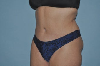 45-54 year old woman treated with Drainless Tummy Tuck after 1672440