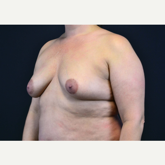 35-44 year old woman treated with Breast Implants before 3441086
