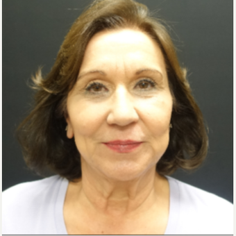 65-74 year old woman treated with Facelift before 3244828