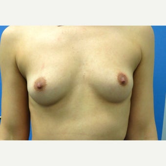 25-34 year old woman treated with Breast Augmentation before 1553690