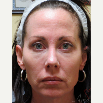 45-54 year old woman treated with Liquid Facelift before 3235358