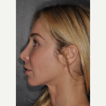 35-44 year old woman treated with Brow Lift 2 weeks post-op after 3452221