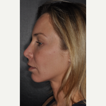 35-44 year old woman treated with Brow Lift 2 weeks post-op before 3452221