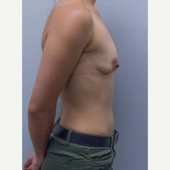 25-34 year old woman treated with Breast Augmentation before 3177017
