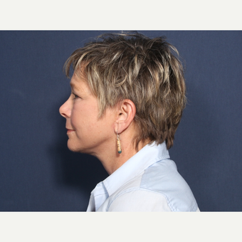 55-64 year old woman treated with Neck Lift (view 2 of 2) after 3175426