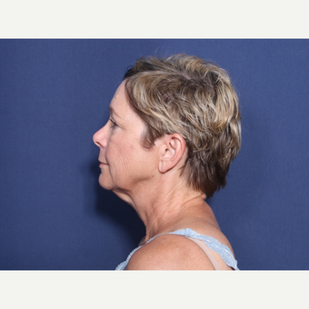 55-64 year old woman treated with Neck Lift (view 2 of 2) before 3175426