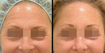 Endoscopic Brow Lift + Lower Blepharoplasty before 658001