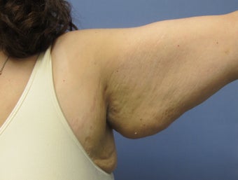 Arm Lift (Brachioplasty) before 3611631