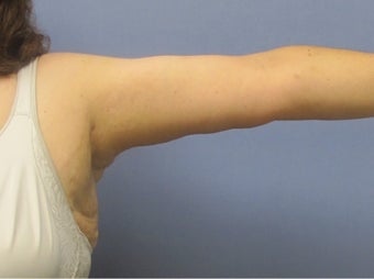 Arm Lift (Brachioplasty) after 3611631