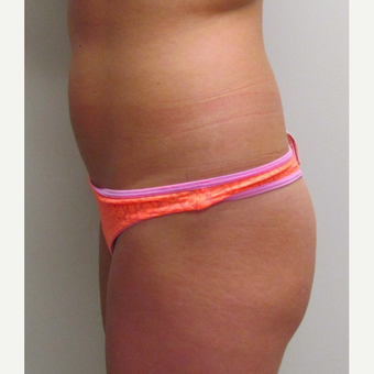 Standard Liposuction for this 27 Year Old Woman before 3791813