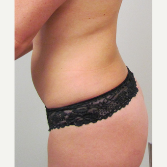 Standard Liposuction for this 27 Year Old Woman after 3791813