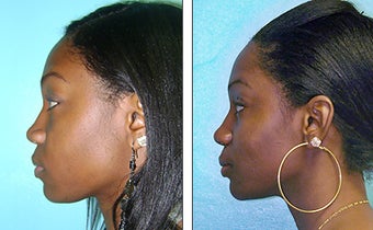 Nose Job- Rhinoplasty before 1116920