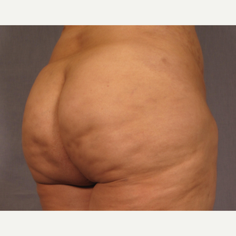 35-44 year old woman treated with Brazilian Butt Lift after 3176641