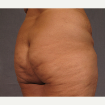 35-44 year old woman treated with Brazilian Butt Lift before 3176641