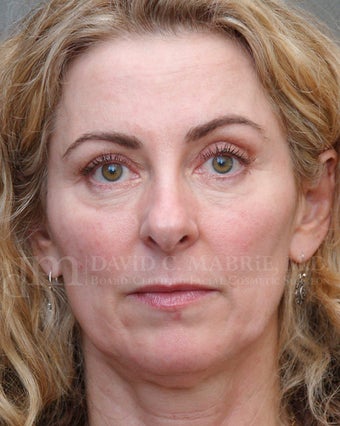 Under Eye Dermafiller, Cheek Dermafiller, Restylane before 208582