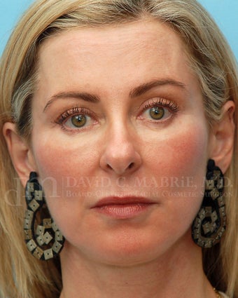 Under Eye Dermafiller, Cheek Dermafiller, Restylane after 208582
