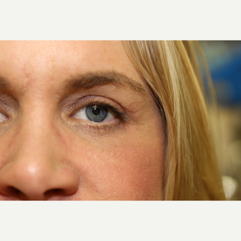 45-54 year old woman treated with Eye Bags Treatment after 3837303