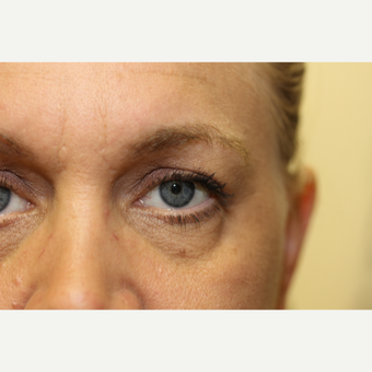 45-54 year old woman treated with Eye Bags Treatment before 3837303