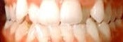 35-44 year old man treated for Braces before 1535140
