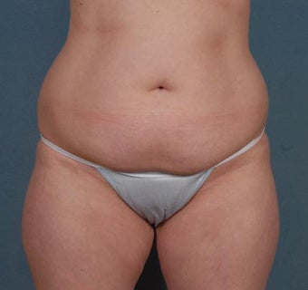 Tummy Tuck, Liposuction before 313075