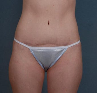Tummy Tuck, Liposuction after 313075