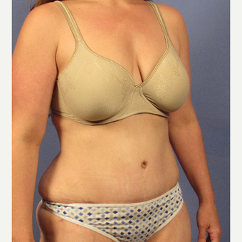 35-44 year old woman treated with Tummy Tuck after 3106707