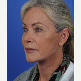 Lower face and upper neck lift done after 3340598