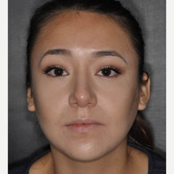 18-24 year old woman treated with Buccal Fat Removal 1 year post-op after 3708624