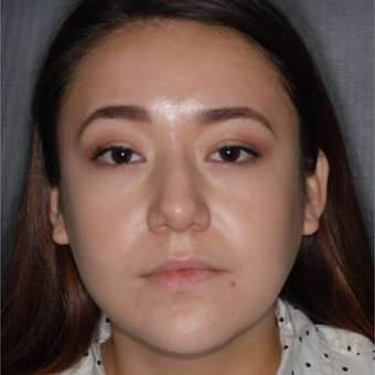 18-24 year old woman treated with Buccal Fat Removal 1 year post-op before 3708624