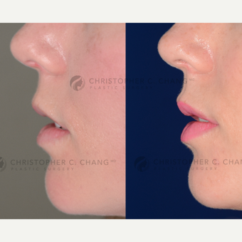 25-34 year old woman treated with Restylane Silk before 3662655