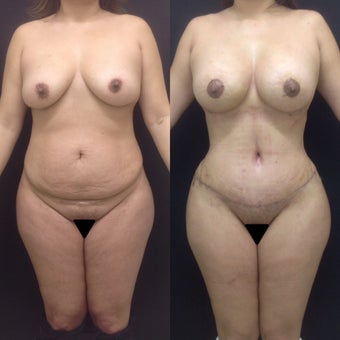 40 Year Old Female; Tummy Tuck + Liposuction before 1074363